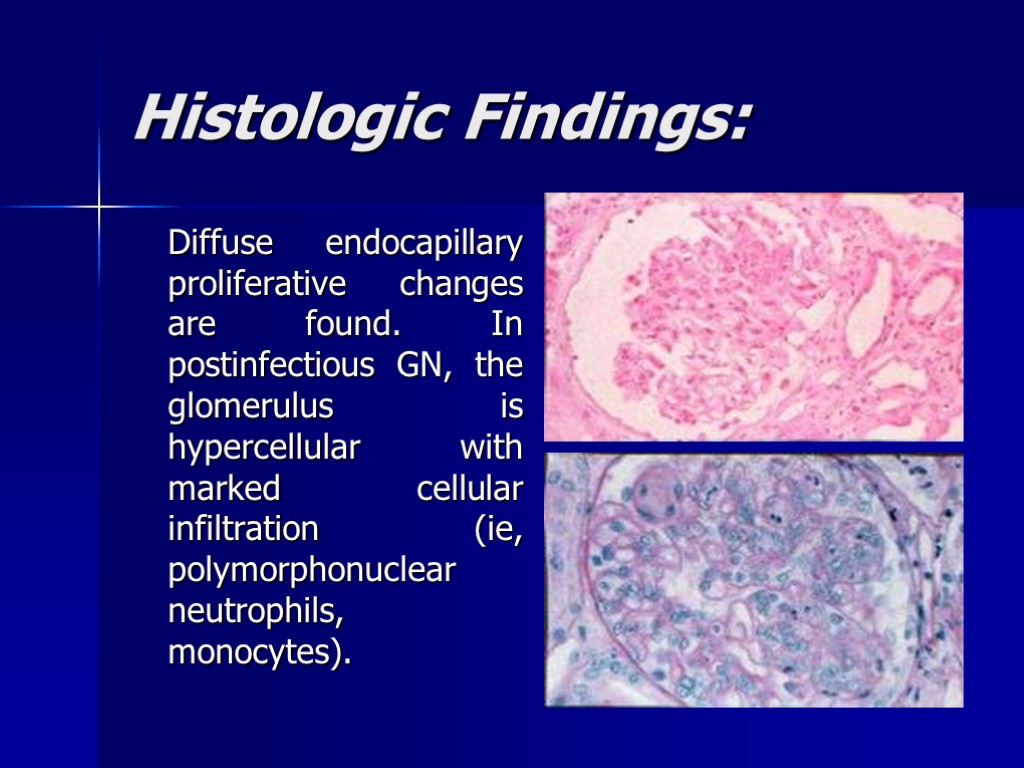 Histologic Findings: Diffuse endocapillary proliferative changes are found. In postinfectious GN, the glomerulus is
